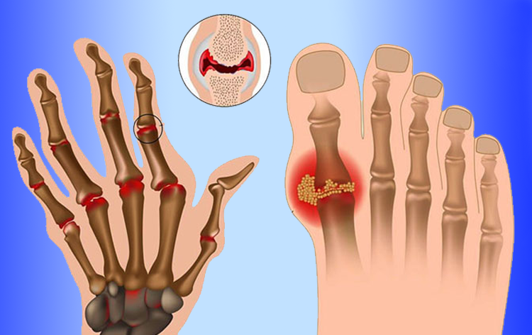 Bệnh gout là gì? Dấu hiệu, nguyên nhân và các biến chứng nguy bệnh gout